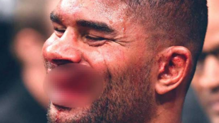 UFC fighter Alistair Overeem's lip explodes in brutal defeat